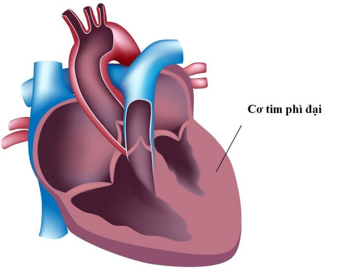 Bệnh lý cơ tim phì đại