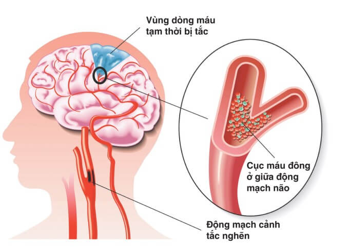 Nhồi Máu Não Xảy Ra Do Thiếu Máu Cung Cấp Lên Não
