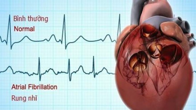 Có Nhiều Nguyên Nhân Gây Ra Rung Tâm Nhĩ