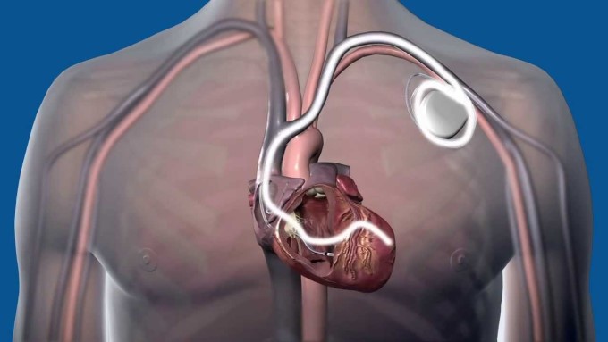 Cấy Máy Khử Rung Giúp Kiểm Soát Nhịp Tim