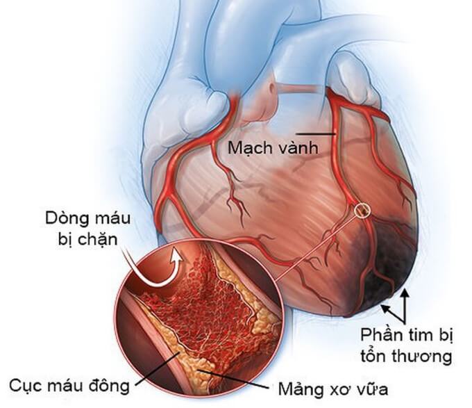 Bệnh lý mạch vành có thể gây suy tim