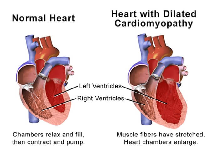 Biến chứng giãn buồng tim do tăng áp động mạch phổi tăng lưu lượng máu qua tim