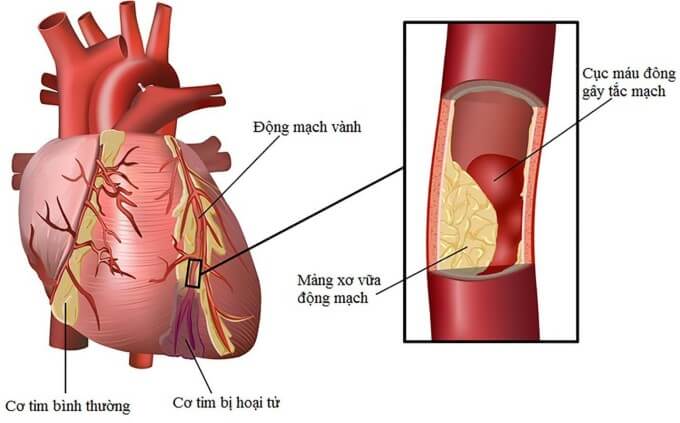 Xơ vữa động mạch vành là nguyên nhân phổ biến gây thiếu máu cục bộ cơ tim