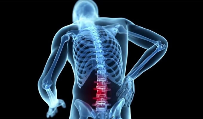Thoái Hoá Côt Sống Thắt Lưng Khiến Người Bệnh Đau, Hạn Chế Vận Động