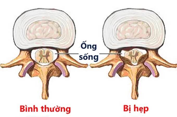 Hẹp Ống Sống