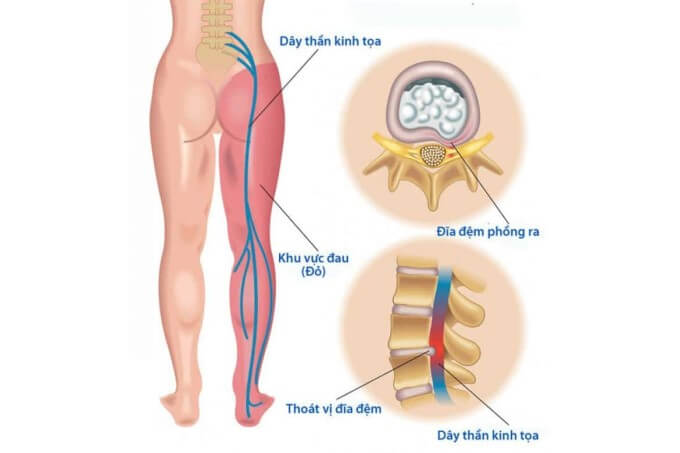 Thoát Vị Đĩa Đệm Nếu Không Được Phát Hiện Và Điều Trị Kịp Thời Có Thể Dẫn Đến Mất Khả Năng Vận Động