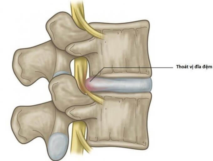Qua Hình Ảnh Chụp Mri Sẽ Thấy Đĩa Đệm Không Nằm Đúng Vị Trí