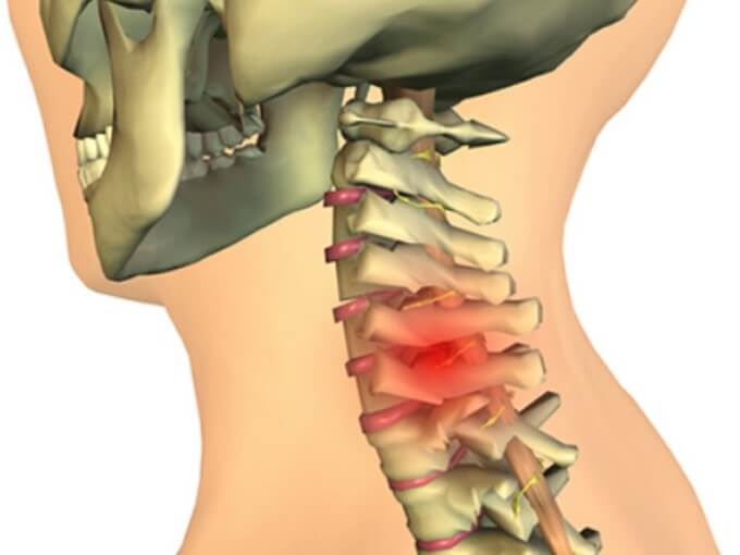 Biến Chứng Chèn Ép Tuỷ Nếu Không Được Điều Trị Kịp Thời Có Thể Gây Tàn Tật Vĩnh Vĩnh Viễn, Thậm Chí Là Tử Vong