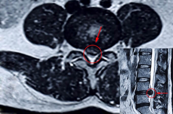 Có 2 phương pháp điều trị ngoại khoa điều trị thoát vị đĩa đệm vùng thắt lưng