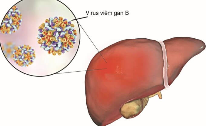 Viêm Gan B Được Cho Là Một Trong Những Yếu Tố Gây Nên Viêm Mạch Máu
