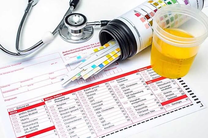 Xét Nghiệm Nước Tiêu Chẩn Đoán Viêm Mạch Máu