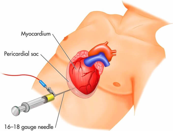 Lấy Dịch Bằng Phương Pháp Chọc Dịch Màng Tim