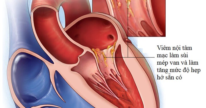 Viêm nội mạc nhiễm trùng van tim: nguyên nhân, triệu chứng và điều trị