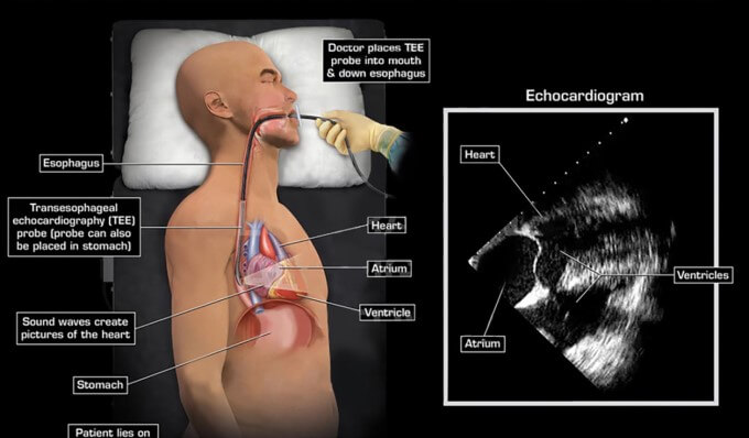 Phương Pháp Siêu Âm Tim Qua Thực Quản