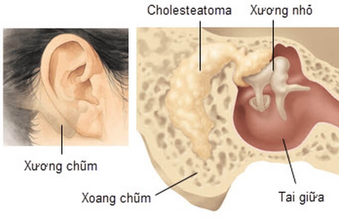 Xương Chũm Là Loại Xương Xốp, Một Bộ Phận Cấu Thành Của Tai Giữa