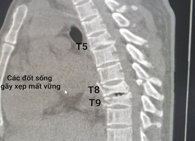 Xẹp Đốt Sống Là Biến Chứng Hay Gặp Của Bệnh Lý Loãng Xương