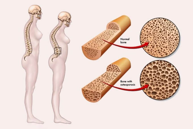 Loãng Xương Là Nguyên Nhân Phổ Biến Gây Xẹp Đốt Sống