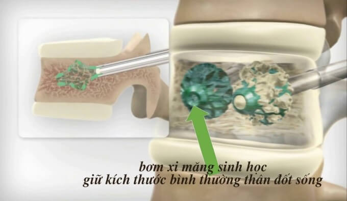Bơm Xi Măng Sinh Học Vào Đốt Sống Bị Xẹp