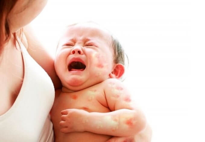 Trẻ Có Thể Bị Dị Ứng Với Các Loại Sữa Ngoài