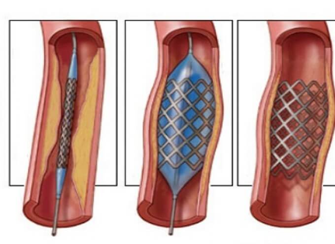 Đặt Stent Trong Điều Trị Hẹp Động Mạch Thận