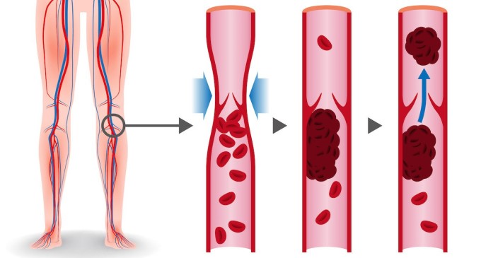 Huyết Khối Tĩnh Mạch Sâu Thường Gặp Nhất Ở Các Tĩnh Mạch Sâu Trong Chân