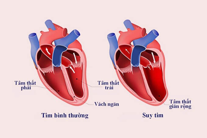 Ngoại Tâm Thu Thất Có Thể Do Suy Tim