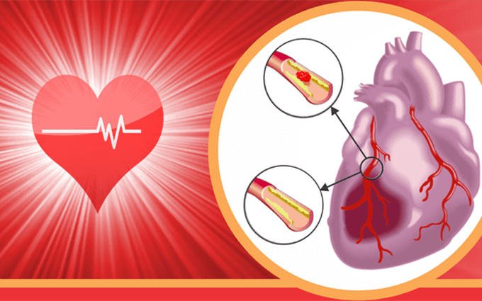 Xơ Vữa Động Mạch Là Nguyên Nhân Chủ Yếu Gây Nhồi Máu Cơ Tim