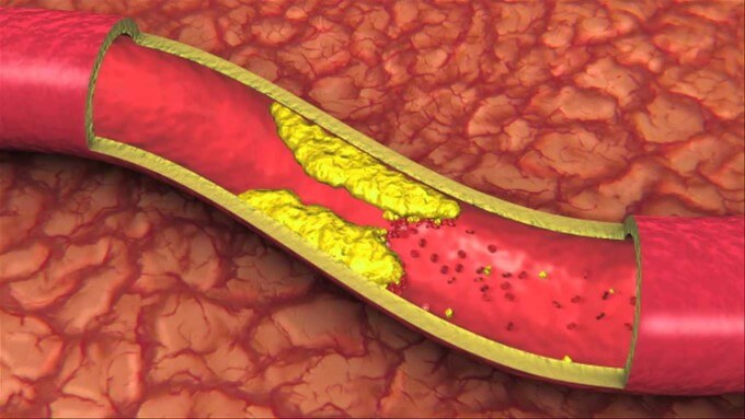 Cholesterol Xấu Gây Tắc Nghẽn Động Mạch