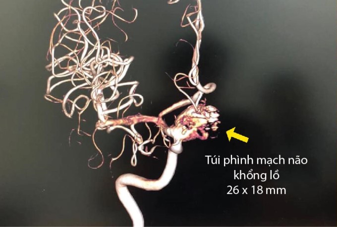 Túi Phình Động Mạch Não Gây Tai Biến Mạch Máu Não