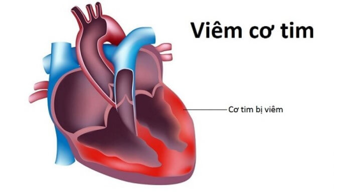 Viêm Cơ Tim Là Tổn Thương Hay Gặp Nhất Trong Bệnh Thấp Tim
