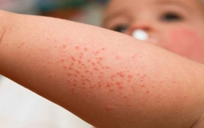 Xuất Hiện Các Nốt Xuất Huyết Trên Da