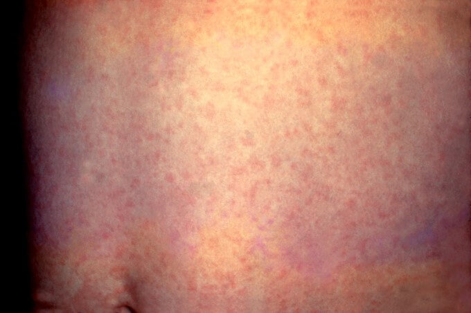 Mắc Rubella Trong Thời Gian Thai Kỳ Làm Tăng Nguy Cơ Mắc Dị Tật Tim Ở Bào Thai