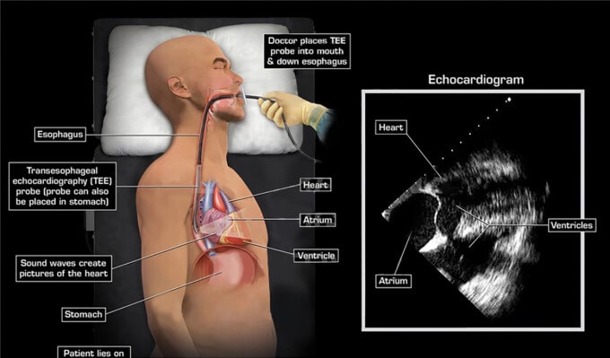 Siêu Âm Tim Qua Thực Quản
