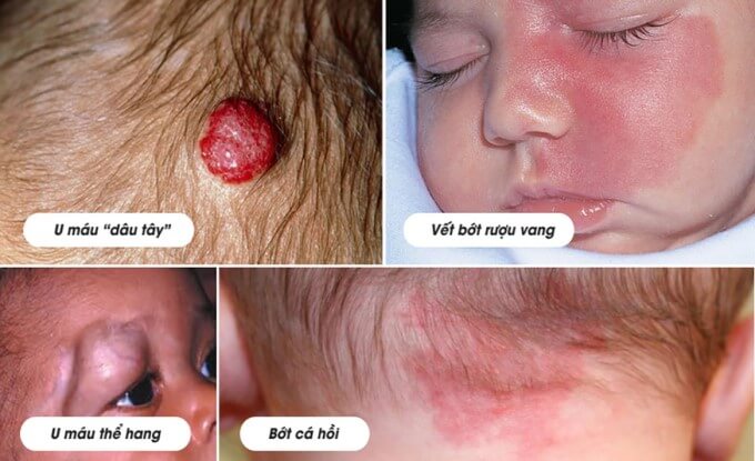 U Mạch Máu Có Nhiều Phân Loại Khác Nhau