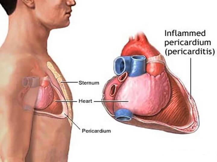 Viêm màng ngoài tim co thắt có nguy hiểm không?