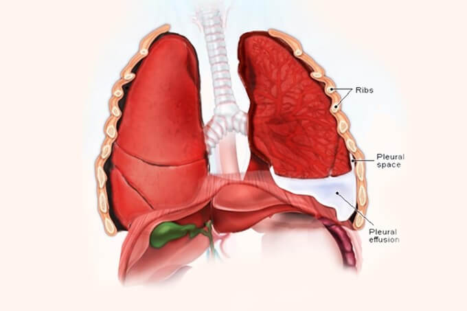 Biến Chứng Tràn Dịch Màng Phổi