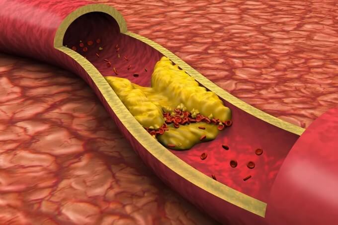 Dha Giúp Làm Giảm Cholesterol Toàn Phần,Dự Phòng Xơ Vữa Động Mạch