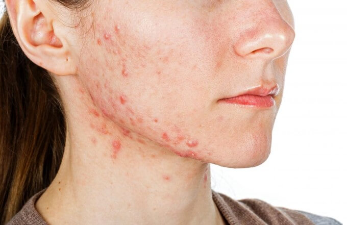 Tác Hại Của Trà Sữa - Nổi Mụn