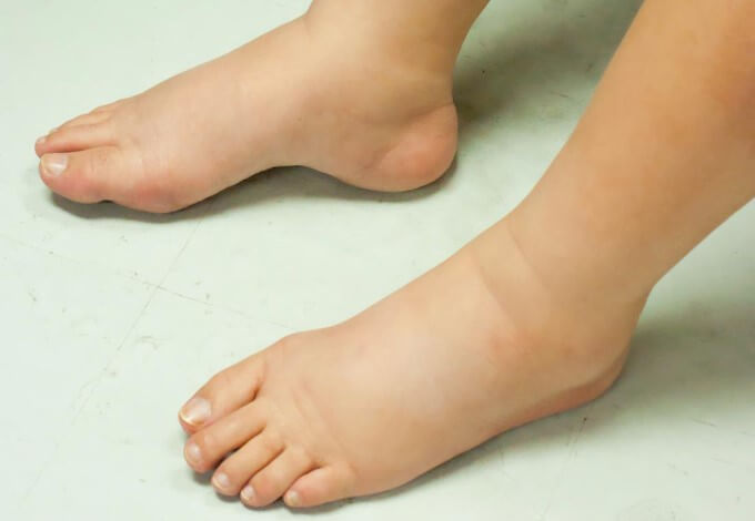 Có Nguy Cơ Mắc Beriberi Do Thiếu Vitamin B1