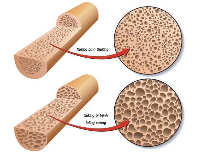 Isoflavone Ngừa Loãng Xương