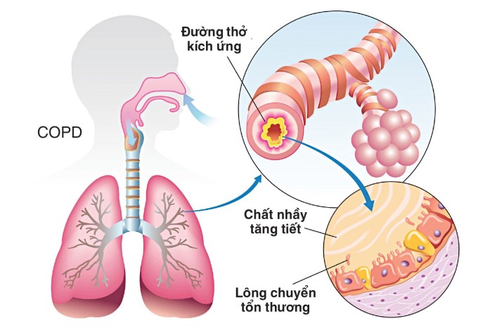 Copd