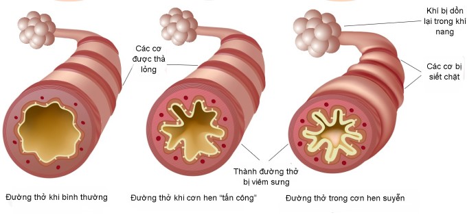 Hen Phế Quản